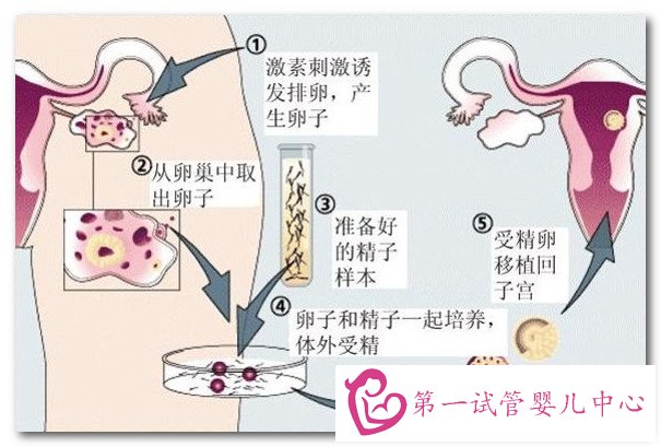 第一试管婴儿中心-试管流程